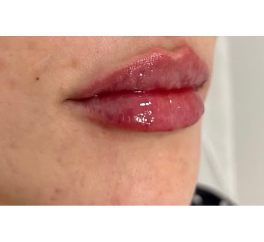 lip enhancement results 2
