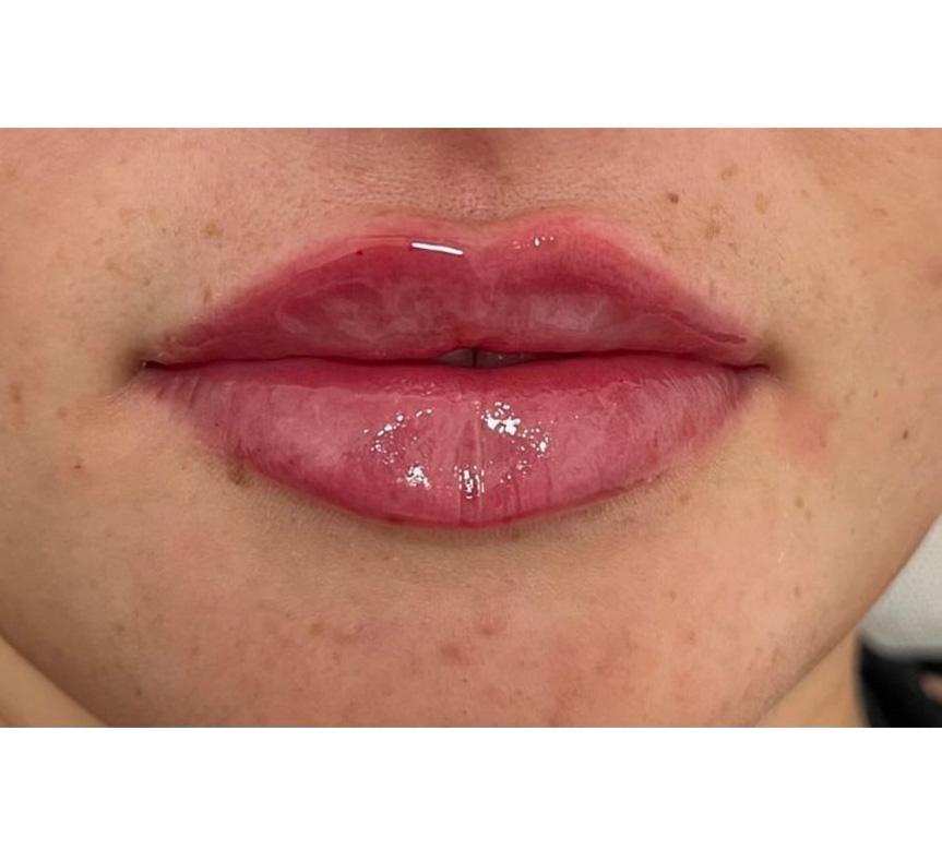 lip enhancement results 3