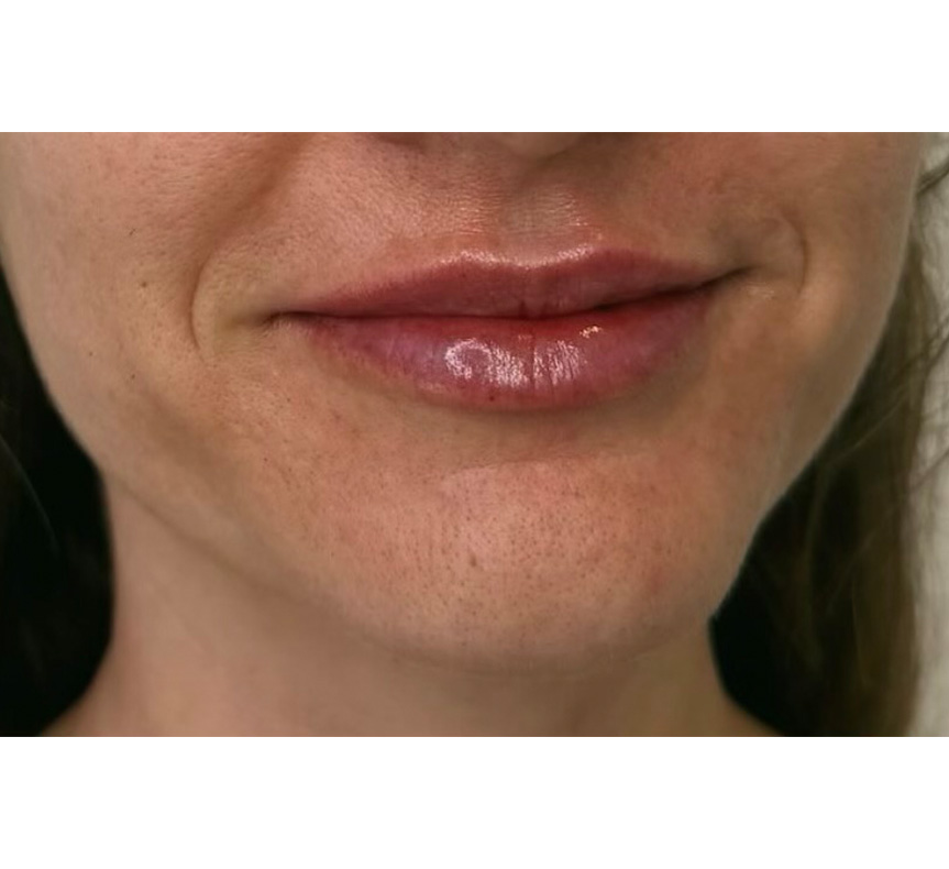 lip enhancement results 5