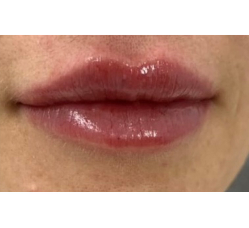 lip enhancement results 7