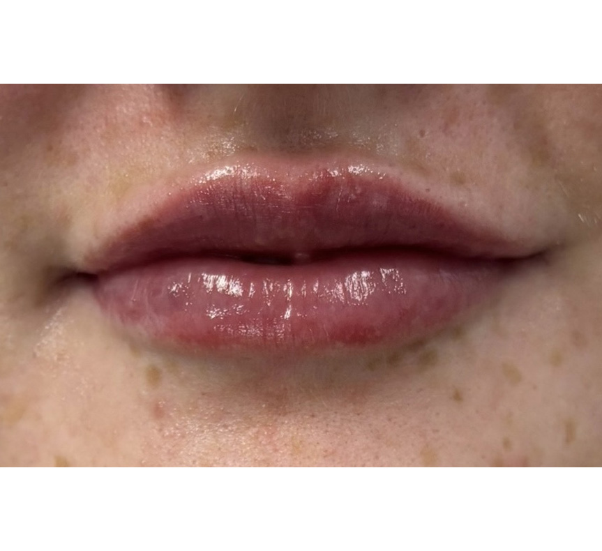 lip enhancement results 8