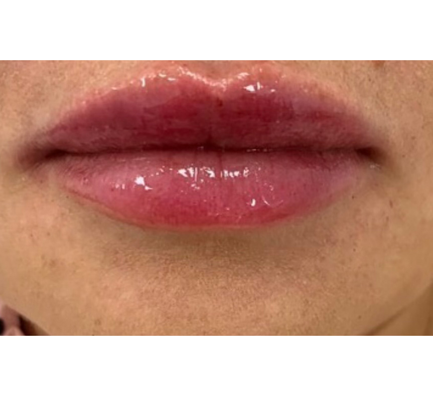 lip enhancement treatment results 1