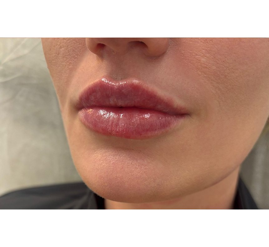 Brisbane Clinic Lip Enhancement Result