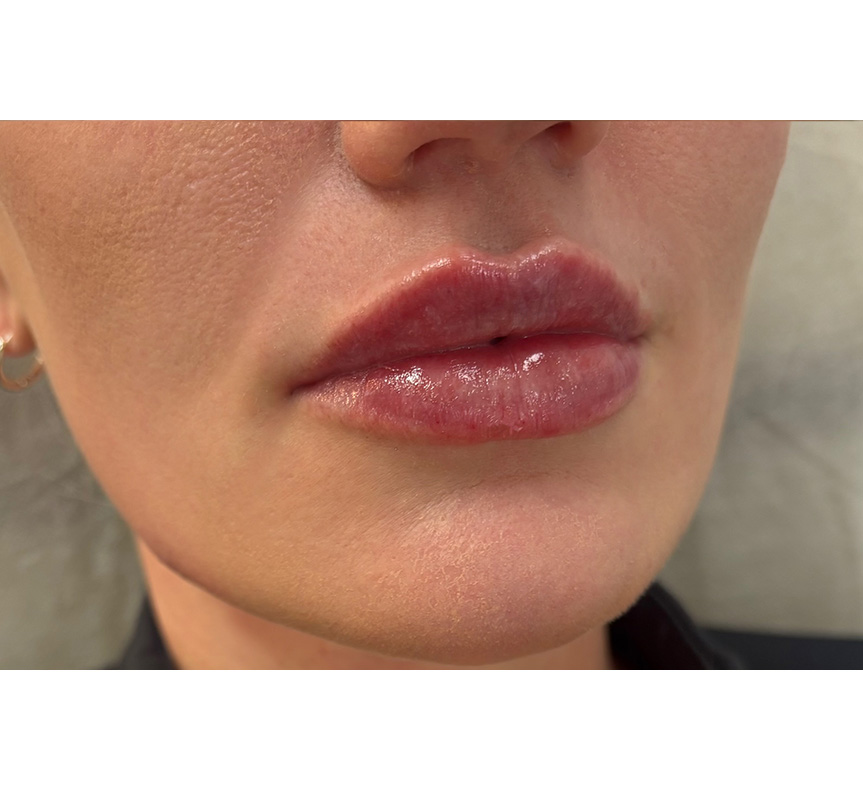 Dermal lip filler result in Brisbane Clinic